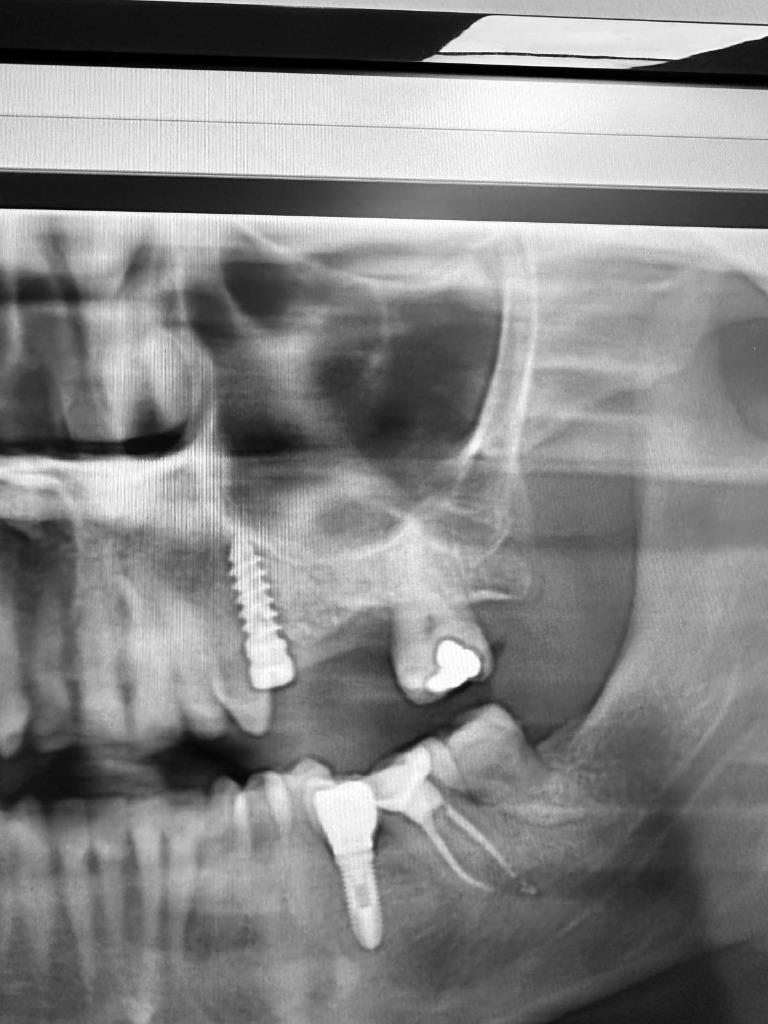 Maxillary Sinus Lift Training